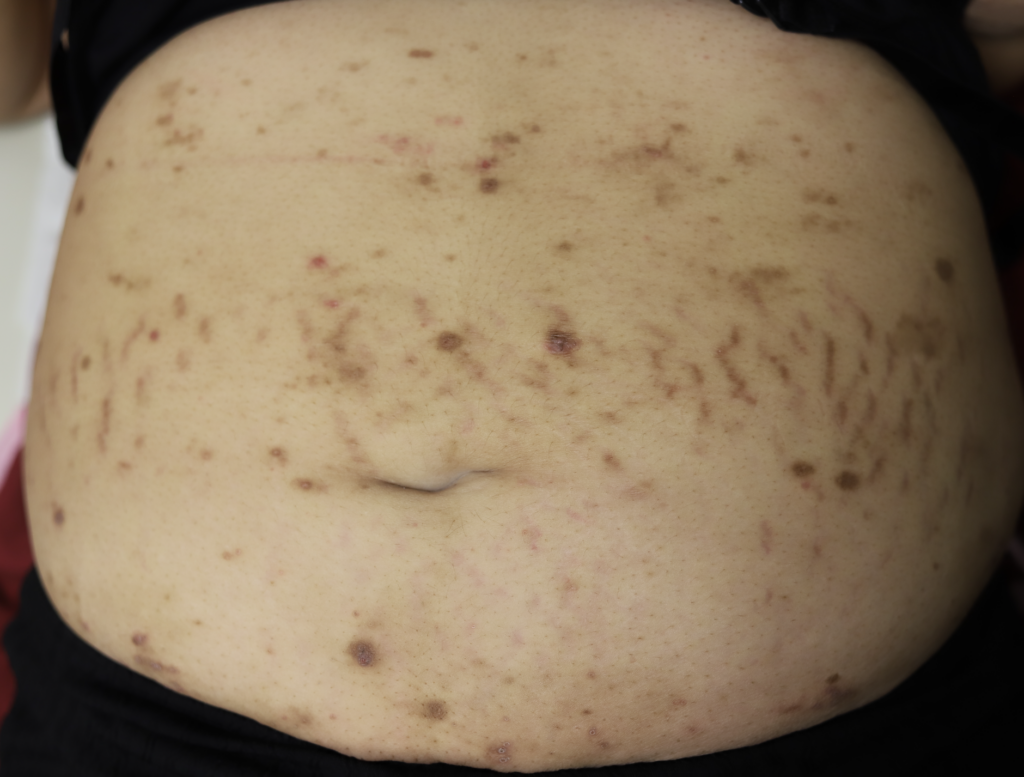 Psoriasis also affecting abdomen and back